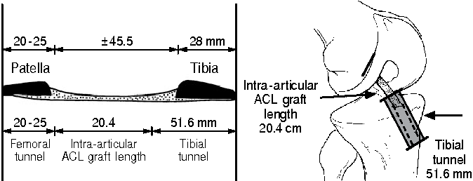 tibial tunnel bone allograft cpt